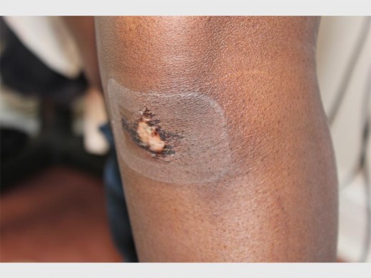 One of Neo Nhlapo's injuries after she was attacked by a security guard at a Hyde Park shopping centre.