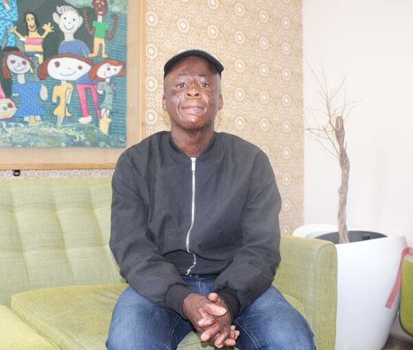 The foundations, supported by Umatter, help burn survivors receive laser therapy at the Nelson Mandela Children’s Hospital every Friday, helping them feel safe, happy, and comfortable in their own skins again.