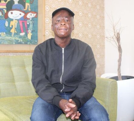 Burn survivor Molemo Tsotetsi on November 14, 2025. Photo: Asanda Matlhare