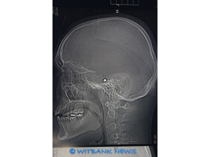 An X-ray depicting the bullet, still lodged in Riaan Erasmus’ skull after he was shot with a .22 calibre rifle.