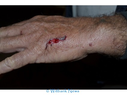 A suspect hit Mr Johan Richards’ hand with a steel pole of some sort.