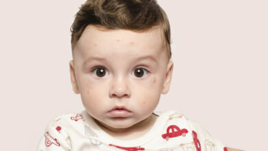 Baby measles: What’s that spot you’ve got?