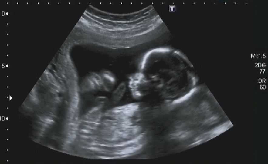 Can an ultrasound at birth reveal autism risk? Brakpan Herald