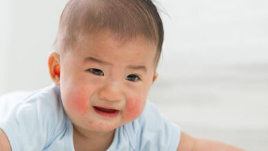Does my baby has topic eczema or seborrheic dermatitis?