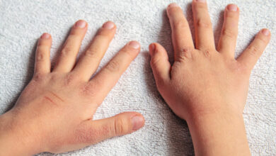 How to treat your child’s dry skin in winter