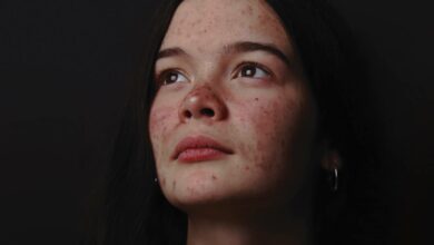 rialienfurstenberg-19-04-2021-lifestyle-psoriasis-photo