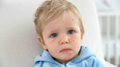 The ins and outs of chickenpox: When your tot has a spot