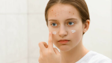Teen troubles: How to overcome skin issues
