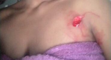 A stab wound sustained by the victim during a gender-based violence attack.