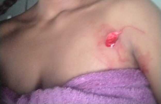A stab wound sustained by the victim during a gender-based violence attack.