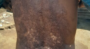 Scabies infection on a person’s abdomen, showing skin rash and irritation, common in densely populated areas like Soweto.
