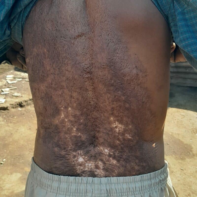 Scabies infection on a person’s abdomen, showing skin rash and irritation, common in densely populated areas like Soweto.