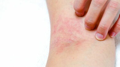 Treating Atopic Dermatitis in babies and children