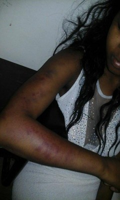 Beatings on the arm