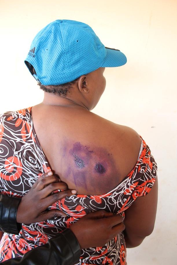 One of the protesters who were shot with rubber bullets.