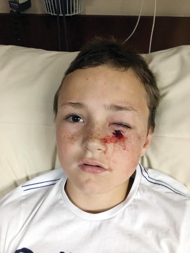 Ryno van der Westhuizen (8) in die hospitaal pas nadat ‘n deurhandvatsel van 5 cm in sy gesig ingesteek het. Slegs ‘n klein stukkie van die handvatsel steek hier by die wond uit.