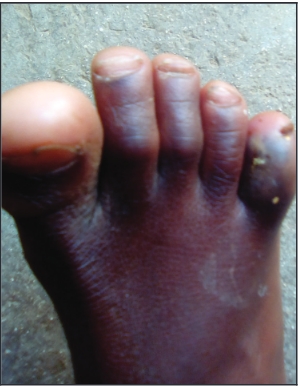 Vuyisile Matubatuba’s swollen foot wor ried his mother. She decided to get it chec ked out before the clinic closed.