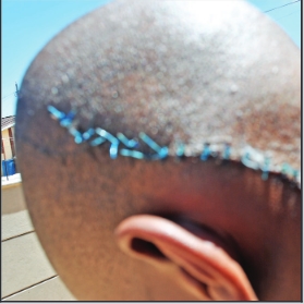The stitched wound after the incident