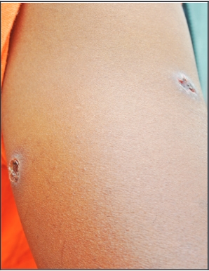 The bullet wound on the victims right arm