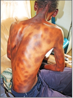 Mr Gracious Kgutlang with the strange skin condition that is part of his allergic reaction to his chro nic medication.