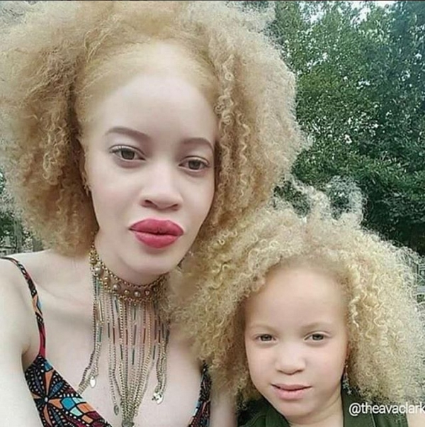 albino3