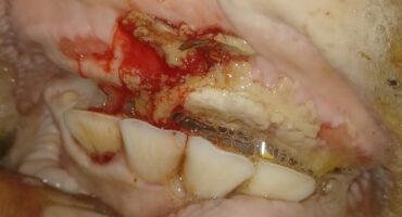 Bekletsels kenmerkend van Bek-en-klouseer.