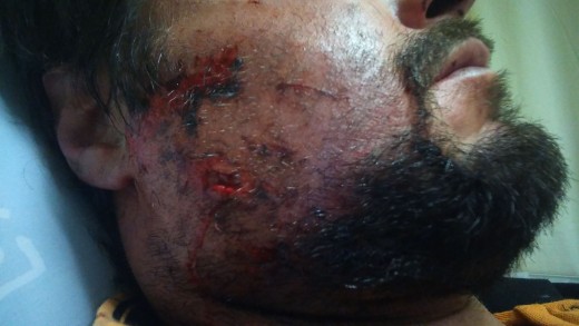 Die wonde wat Juan Grobler opgedoen het na die koedoe sy motor getref het.