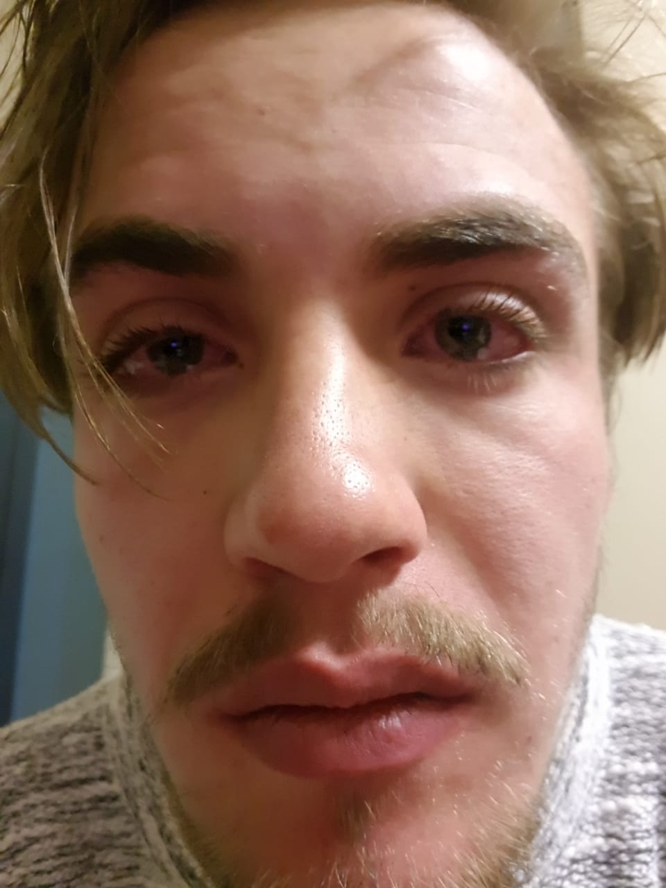 Nicolas se gesig was erg geswel na die aanval. Foto: Verskaf