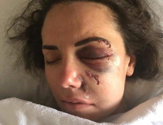 Nanna Viviers die oggend nadat haar oog geopereer is. Foto: Verskaf