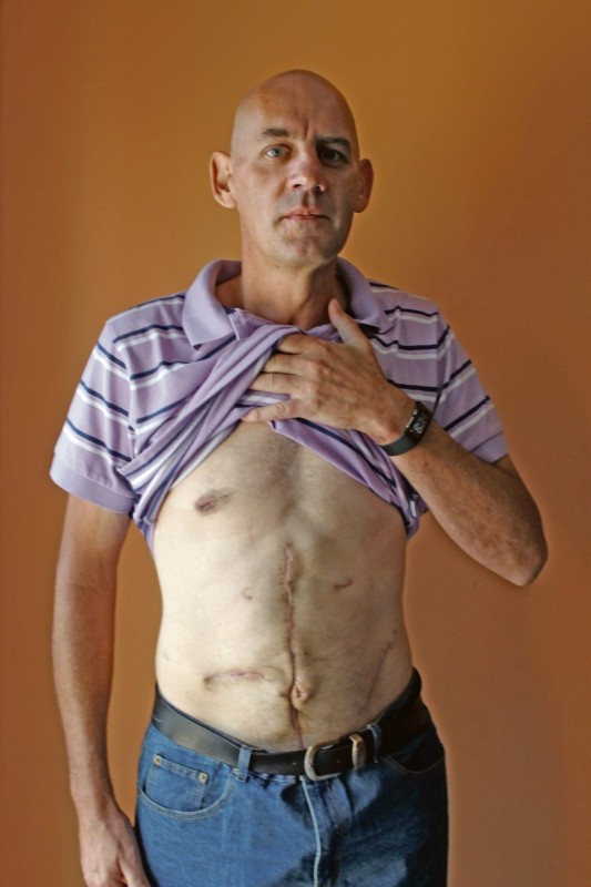 Arend wys die merke op sy bo-lyf na die operasies wat hy moes ondergaan. Foto: Carla du Plessis
