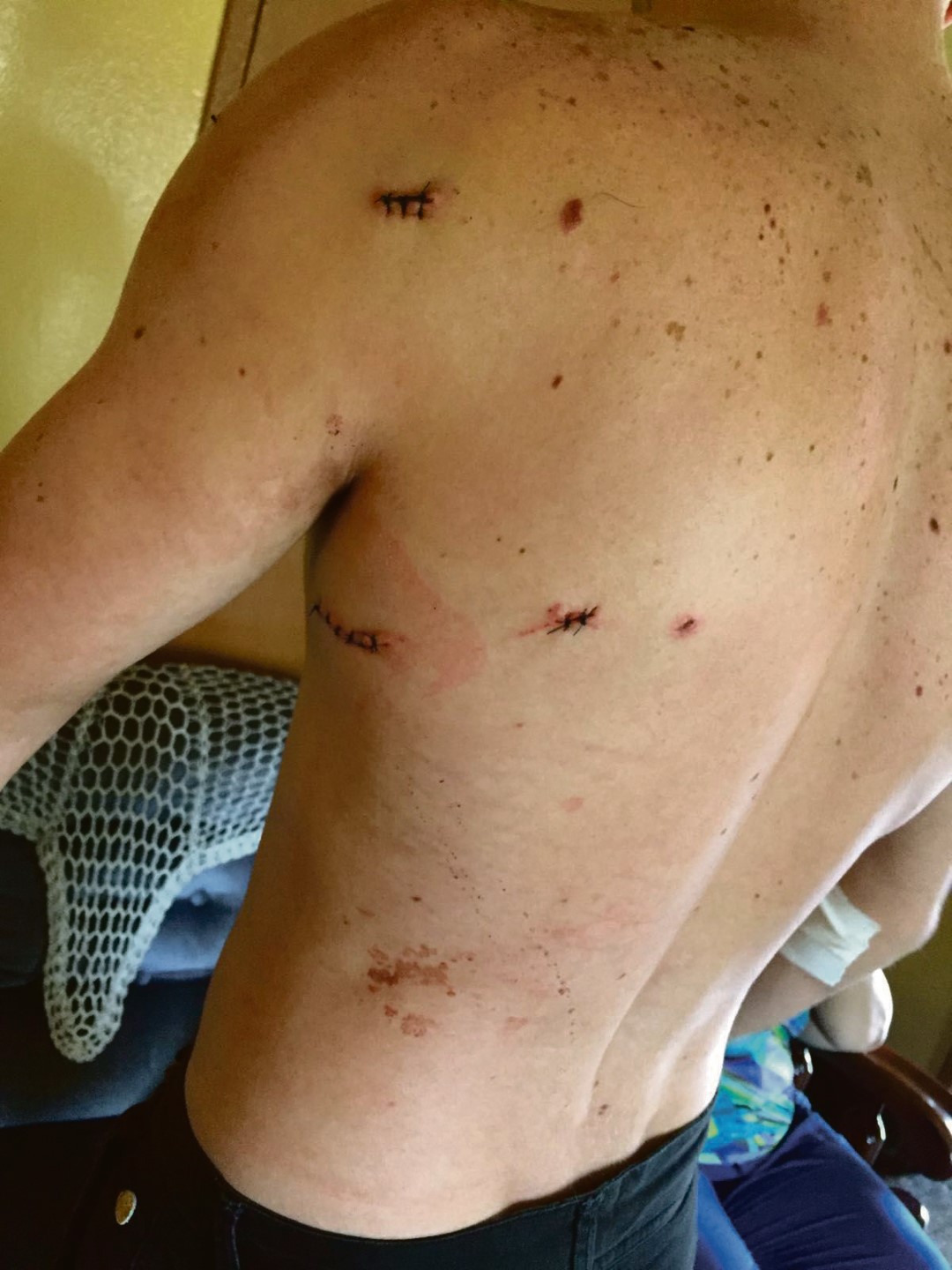 Jaen Moolman het vier steekwonde aan sy bolyf opgedoen tydens die geveg met rowers, wat hom in Mario Milani-rylaan oorval het.