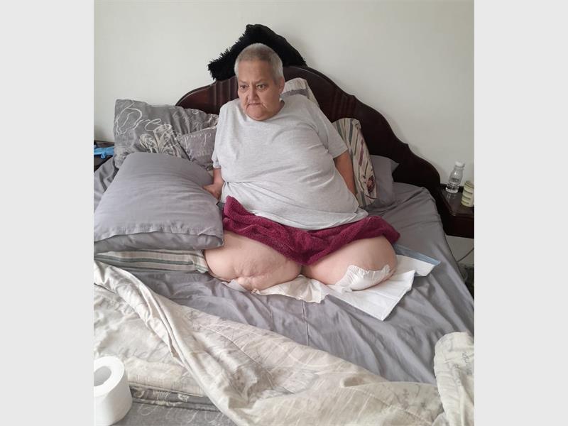 ’n Inwoner van Heidelberg staar groot uitdagings in die gesig ná die amputasie van albei haar bene. Haar familie doen ’n dringende beroep op die gemeenskap om met noodsaaklike hulpmiddels en aanpassings te help.