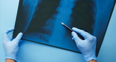 A doctor examines an x-ray of a patients lungs. Photo: Pexels