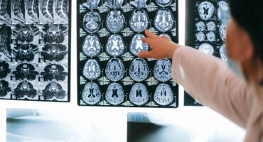 UP researchers unlock new way to monitor brain diseases