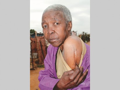 Scars for a better and free South Africa. Clara Ntsepe (62) of the Soul City informal settlement shows the marks on her shoulder that she got during the 16 June 1976 uprising.