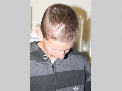 Die wond aan Gary Botha se kop nadat 'n aanvaller sy kop teen 'n badkamerdeur geslaan het.