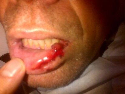 Danie Bruwer se lip is stukkend geslaan.
