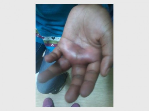 A 12-year-old girl's hand was broken after her teacher punished her with a steel pipe.