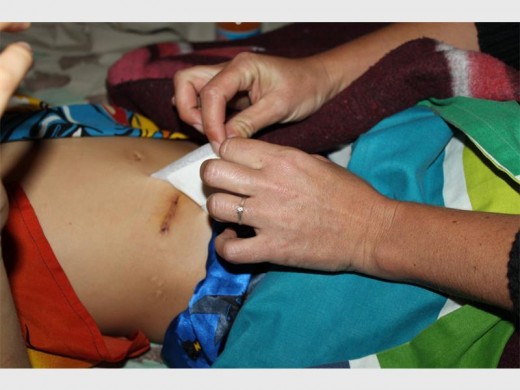 Zander se wond wat volgens Tanya vir die eerste keer, vier dae na die operasie, deur haar skoongemaak is.