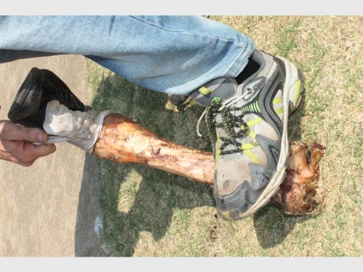 A brave resident undressing the bone.