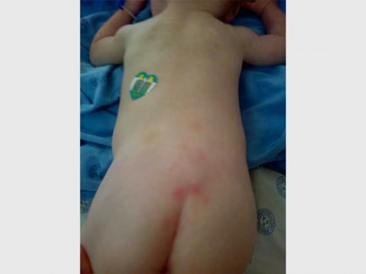 The unexplained red marks on the nine-month-old baby's back.