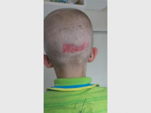 Caden's scar after surviving a brick attack.