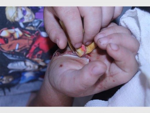 Jorden Davie slowly takes off the bandage around his wound on his right hand.