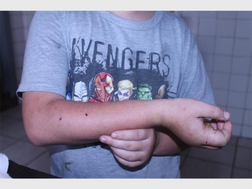 Jorden Davies shows bite marks on his arm from the dog attack.