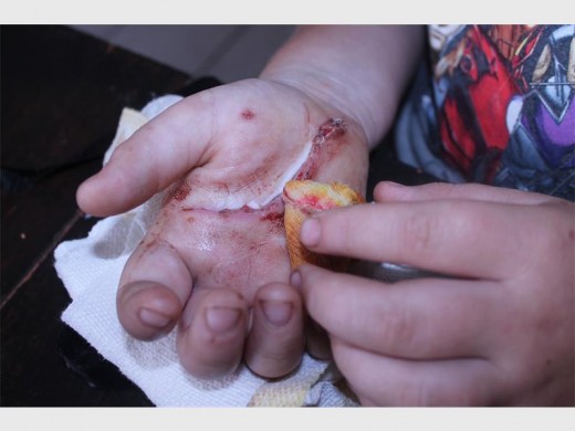 Jorden Davies was attacked by a neighbour's dog.