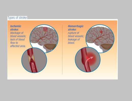 Knowing the types, signs and causes of a stroke can easily increase your chances of surviving one.   Photo: Salinas