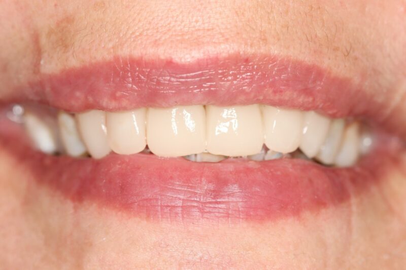 Cosmetic dentistry has evolved significantly in recent years, with modern techniques allowing for more conservative and personalised treatment approaches than ever before.