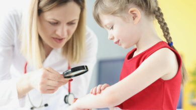 How to treat and control eczema in children