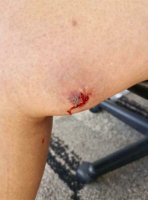 The bullet wound.