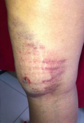 Michelle Singh shows her injury.